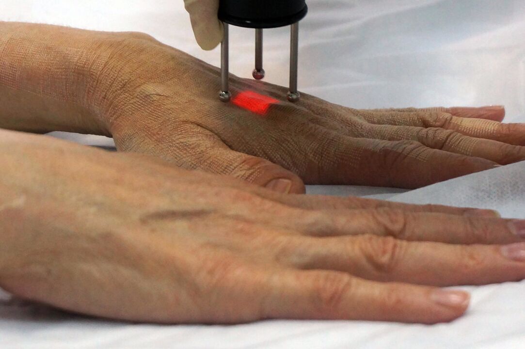 Laserové omlazení rukou neablativní metodou
