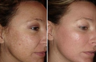 laserové omlazení pleti obličeje před a po fotografiích